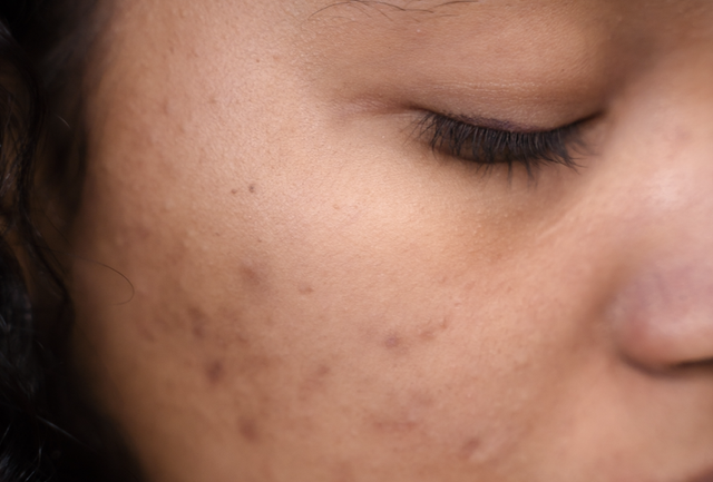 Both the causes and treatment for a damaged skin barrier and acne is different.