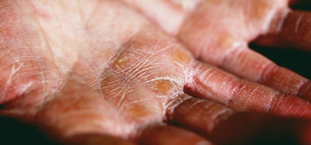 dry hands in winter