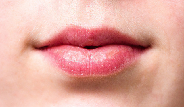 Dry mouth can also cause dry lips.