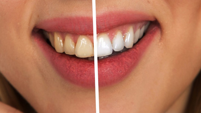 Natural teeth whitening home remedies methods brighten whitened teeth