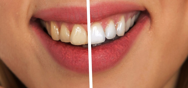 Natural teeth whitening home remedies methods brighten whitened teeth