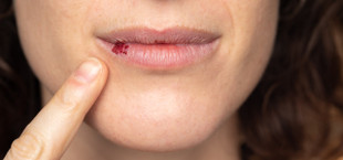 what causes chapped lips
