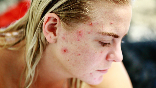 home remedies for acne scars overnight