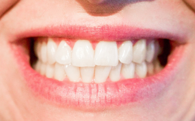 avoid teeth whitening home remedies