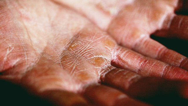 dry hands in winter